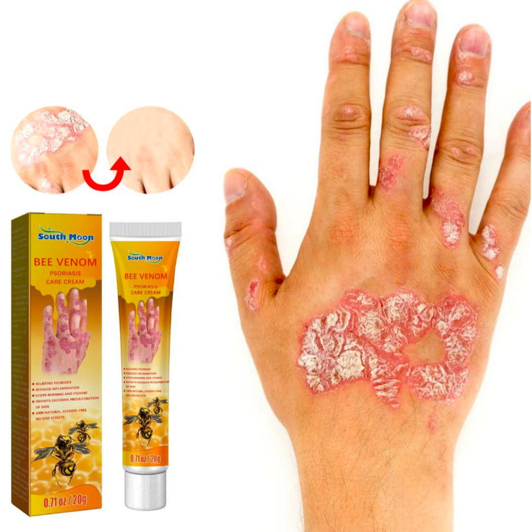 Crème Bee Venom Psoriasis